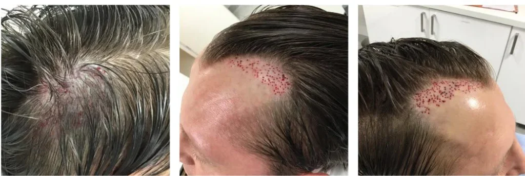 최종 제거 모낭 이식